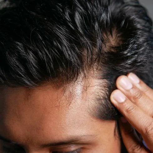 Receding Hairline & Early Thinning